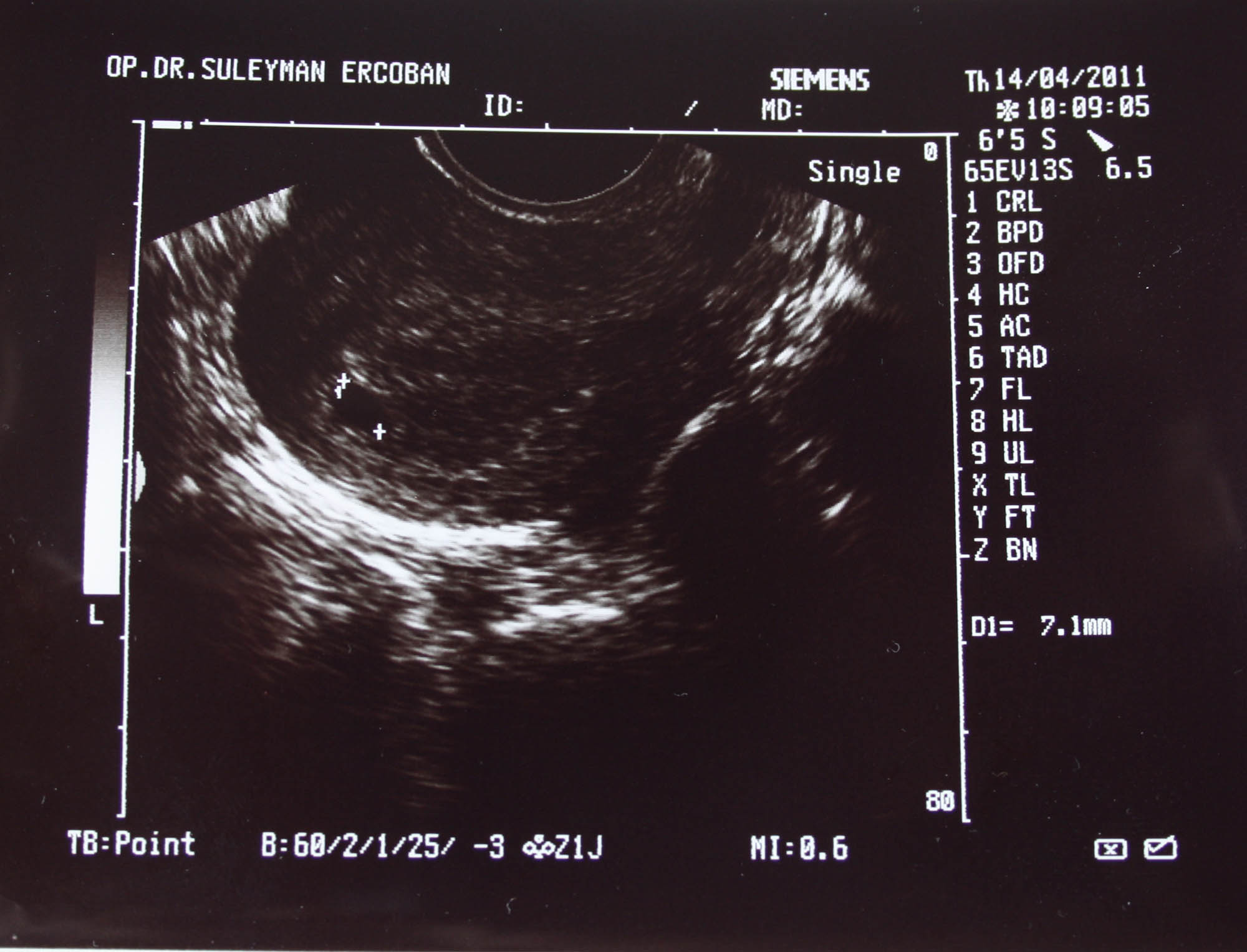 УЗИ > 5 Неделя беременности > алеся